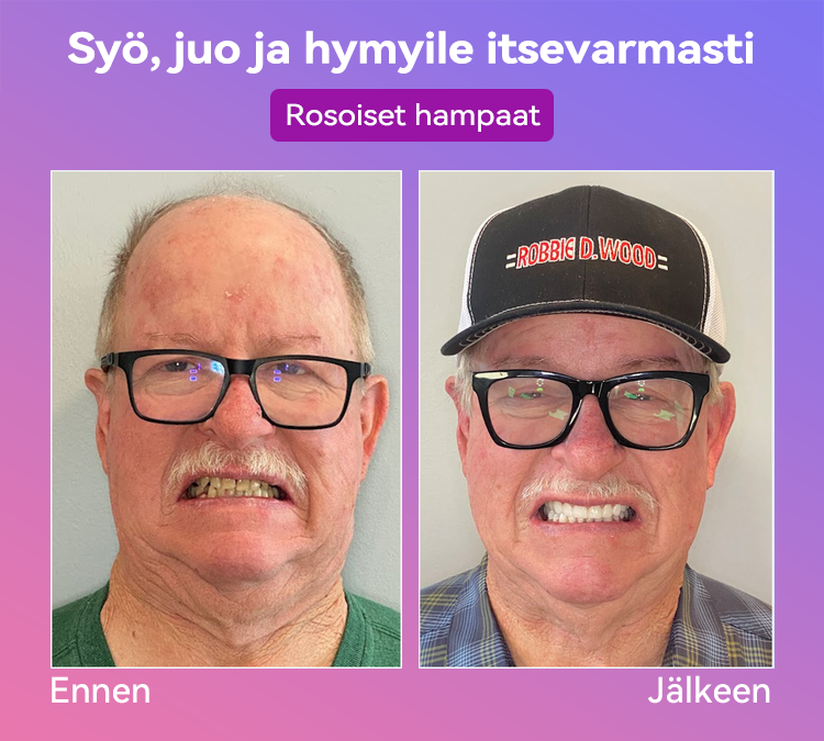 𝐉𝐚𝐬𝐬𝐞𝐞𝐦® Uusimmat Premium Comfort -Tandproteesit🎉 (Huipputason proteesit, helppo käyttää - Rajoitettu aika 70 % alennus)🔥