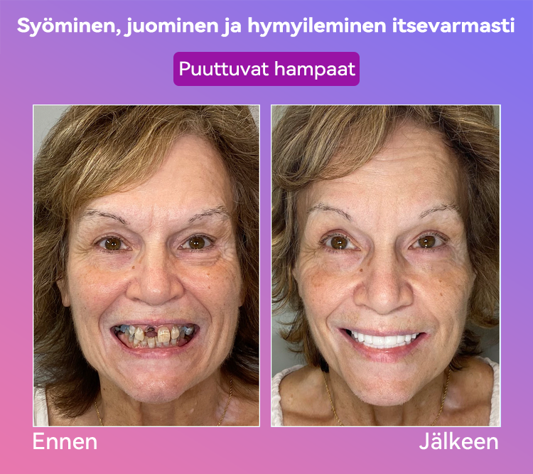 𝐉𝐚𝐬𝐬𝐞𝐞𝐦® Uusimmat Premium Comfort -Tandproteesit🎉 (Huipputason proteesit, helppo käyttää - Rajoitettu aika 70 % alennus)🔥