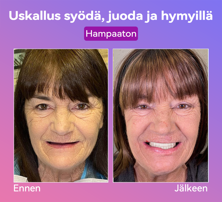𝐉𝐚𝐬𝐬𝐞𝐞𝐦® Uusimmat Premium Comfort -Tandproteesit🎉 (Huipputason proteesit, helppo käyttää - Rajoitettu aika 70 % alennus)🔥