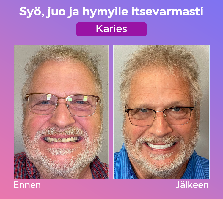 𝐉𝐚𝐬𝐬𝐞𝐞𝐦® Uusimmat Premium Comfort -Tandproteesit🎉 (Huipputason proteesit, helppo käyttää - Rajoitettu aika 70 % alennus)🔥