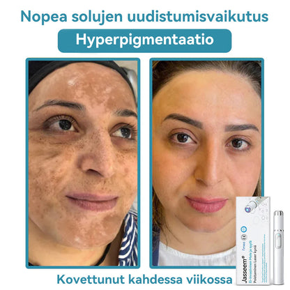 𝐉𝐚𝐬𝐬𝐞𝐞𝐦® lääkinnällisen tason laserpeni 🚚🎁 (käyttää hiilidioksidilasertekniikkaa – poistaa tehokkaasti luomet, syylät, ihotagit, pigmenttiläiskät ja muut ihon virheet)