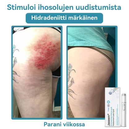 𝐉𝐚𝐬𝐬𝐞𝐞𝐦® lääkinnällisen tason laserpeni 🚚🎁 (käyttää hiilidioksidilasertekniikkaa – poistaa tehokkaasti luomet, syylät, ihotagit, pigmenttiläiskät ja muut ihon virheet)