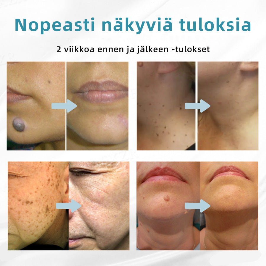 𝐉𝐚𝐬𝐬𝐞𝐞𝐦® lääkinnällisen tason laserpeni 🚚🎁 (käyttää hiilidioksidilasertekniikkaa – poistaa tehokkaasti luomet, syylät, ihotagit, pigmenttiläiskät ja muut ihon virheet)