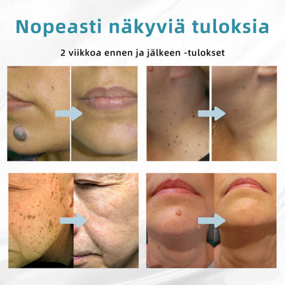 𝐉𝐚𝐬𝐬𝐞𝐞𝐦® lääkinnällisen tason laserpeni 🚚🎁 (käyttää hiilidioksidilasertekniikkaa – poistaa tehokkaasti luomet, syylät, ihotagit, pigmenttiläiskät ja muut ihon virheet)