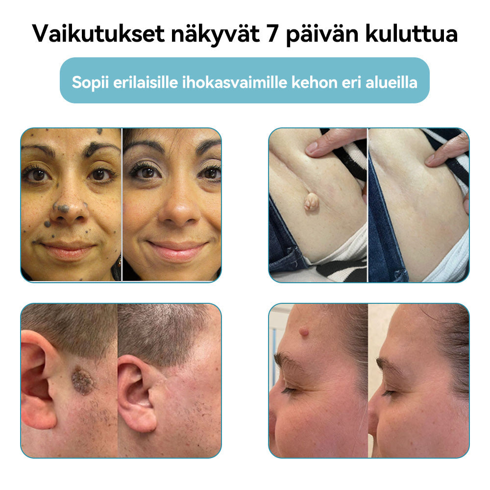 𝐉𝐚𝐬𝐬𝐞𝐞𝐦® lääkinnällisen tason laserpeni 🚚🎁 (käyttää hiilidioksidilasertekniikkaa – poistaa tehokkaasti luomet, syylät, ihotagit, pigmenttiläiskät ja muut ihon virheet)
