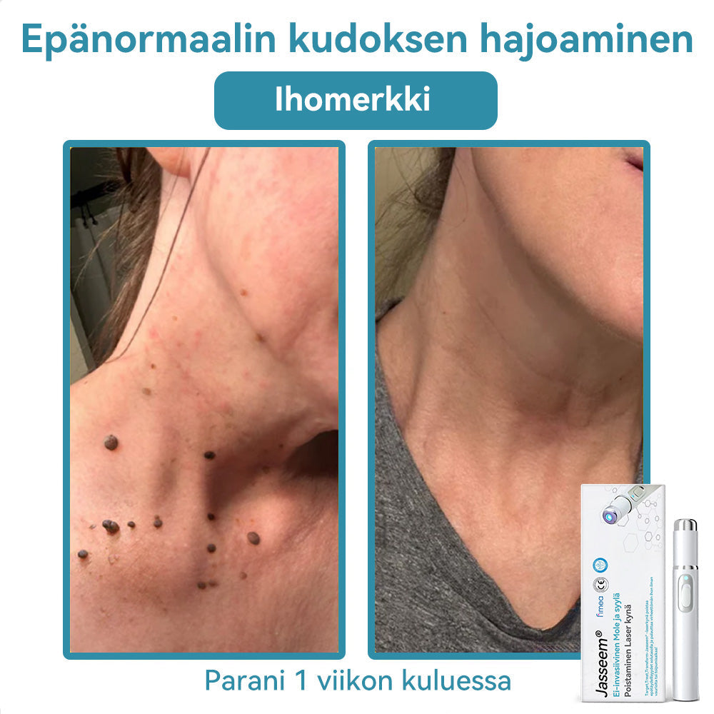 𝐉𝐚𝐬𝐬𝐞𝐞𝐦® lääkinnällisen tason laserpeni 🚚🎁 (käyttää hiilidioksidilasertekniikkaa – poistaa tehokkaasti luomet, syylät, ihotagit, pigmenttiläiskät ja muut ihon virheet)