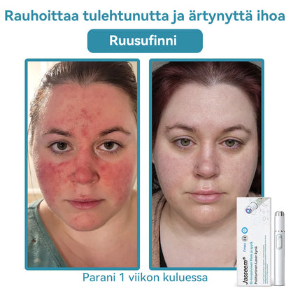 𝐉𝐚𝐬𝐬𝐞𝐞𝐦® lääkinnällisen tason laserpeni 🚚🎁 (käyttää hiilidioksidilasertekniikkaa – poistaa tehokkaasti luomet, syylät, ihotagit, pigmenttiläiskät ja muut ihon virheet)